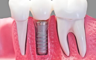 Will Dental Implants Really Work If My Teeth Fell Out?